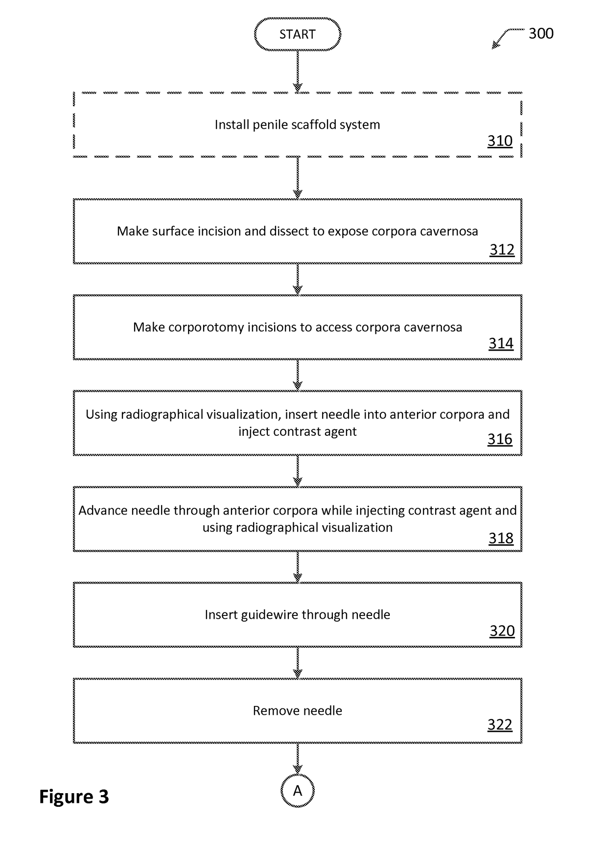 Penile surgery systems and methods