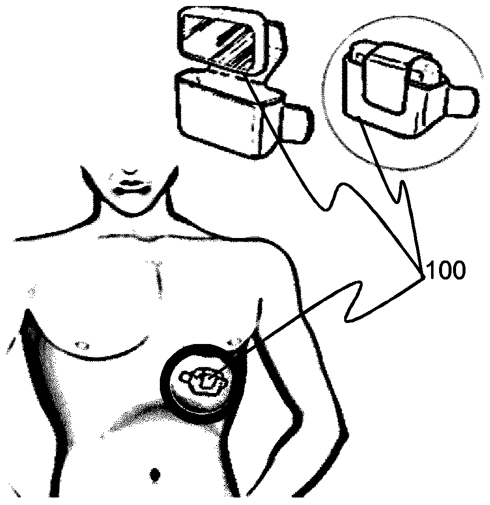 Systems and methods for suppressing peaks in a seismocardiogram