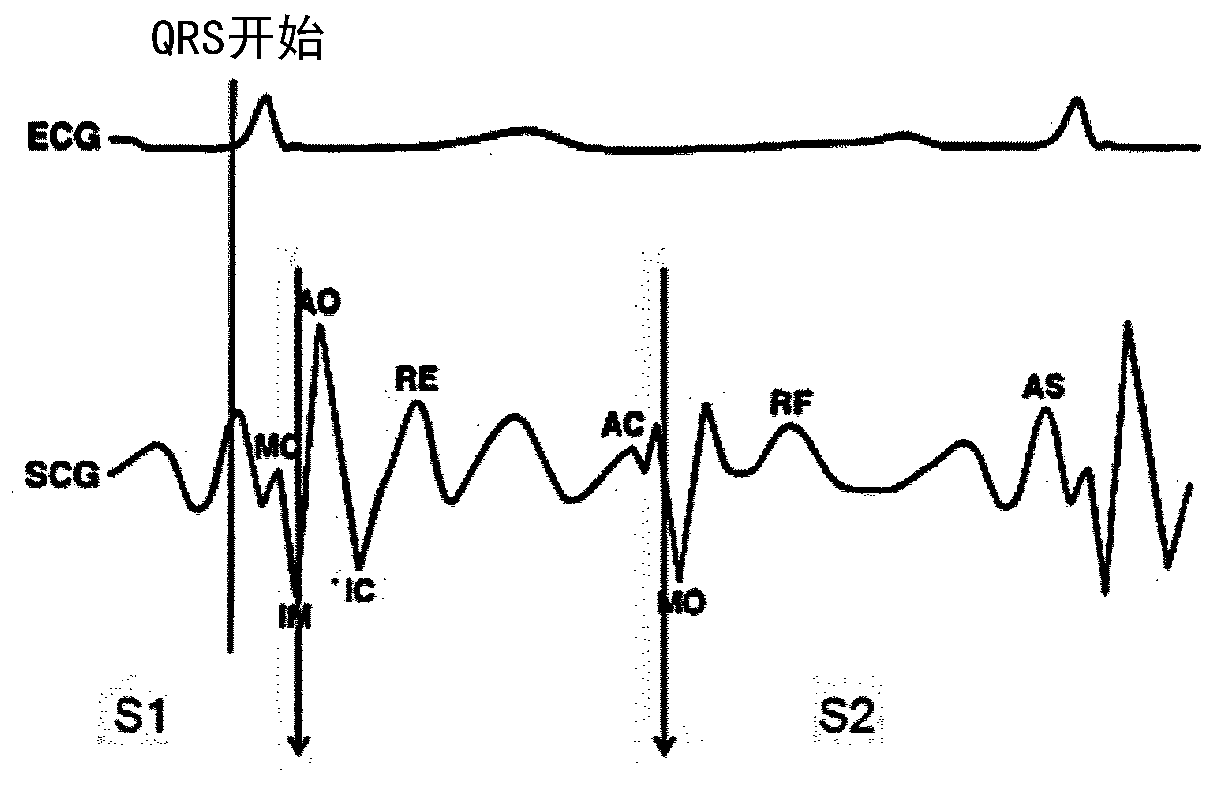 Systems and methods for suppressing peaks in a seismocardiogram