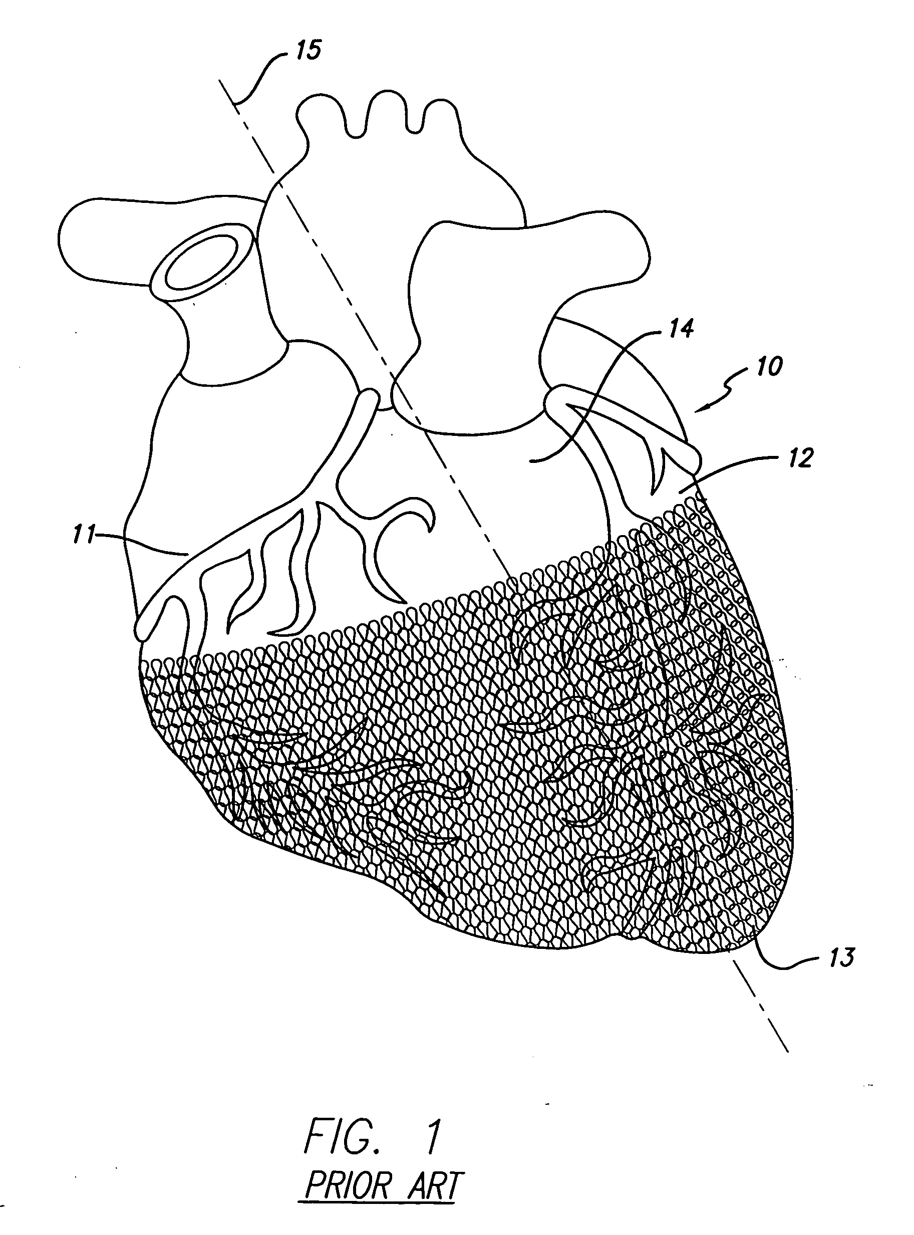 Cardiac harness for treating congestive heart failure and for defibrillating and/or pacing/sensing