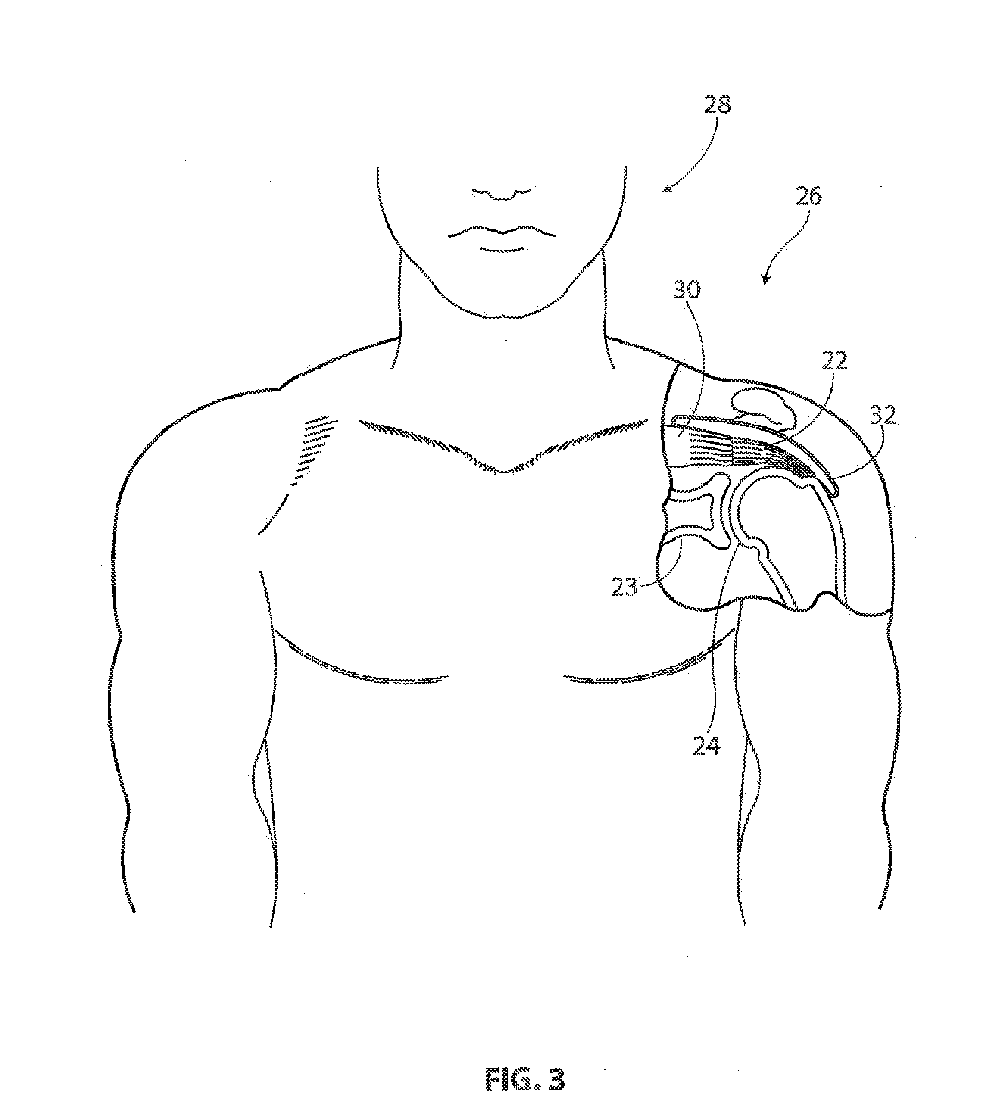 Tendon repair implant and method of implantation