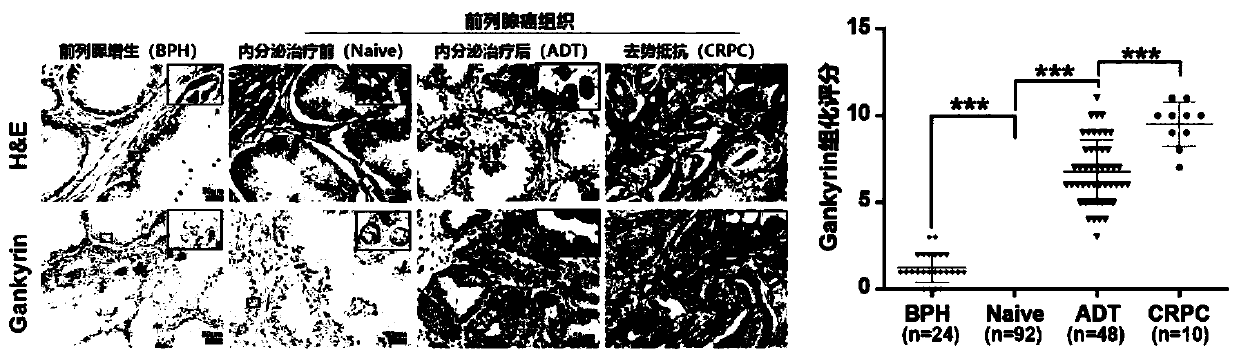 Application of Gankyrin protein as novel molecular marker in prognosis evaluation of prostate cancer