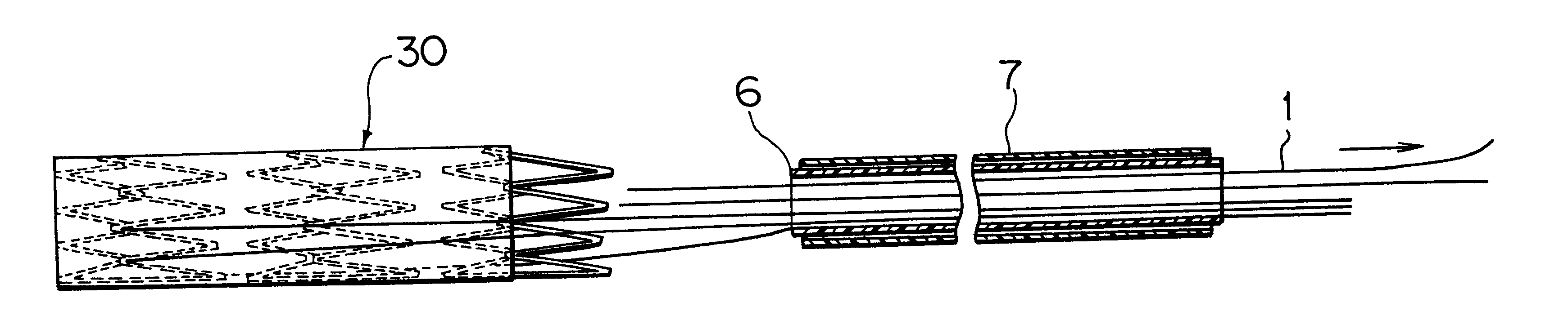 Stent (or stent graft) locating device