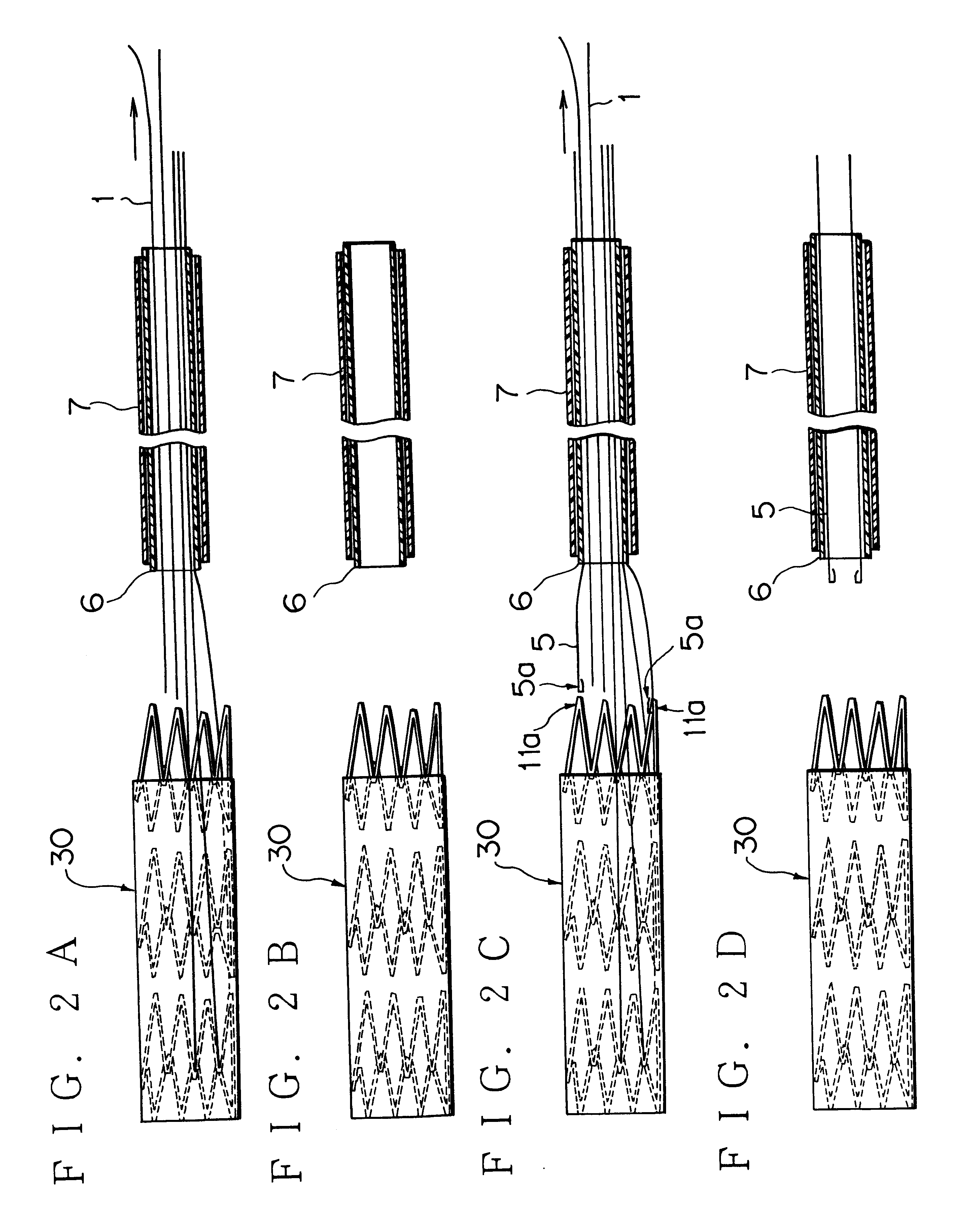 Stent (or stent graft) locating device