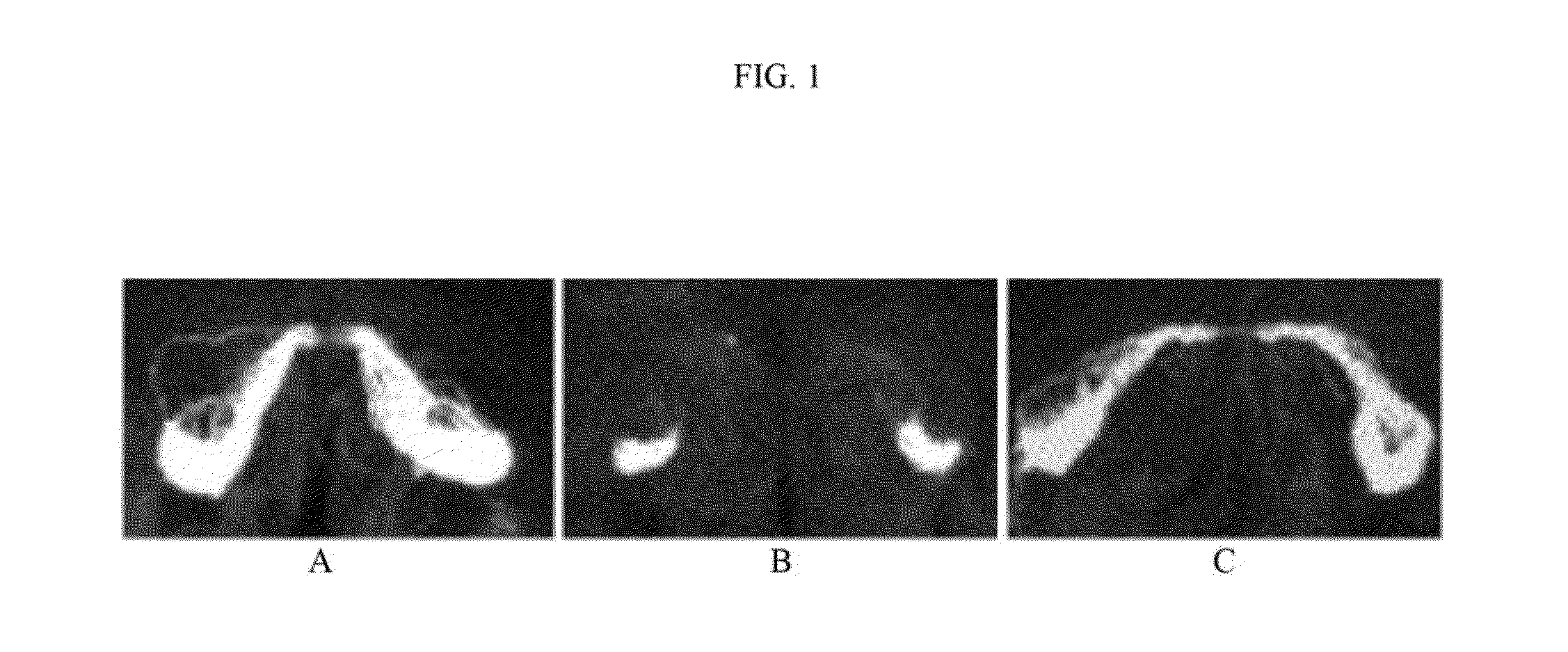 Methods and compositions for inhibition of axonal degeneration by modulation of the dlk/jnk pathway