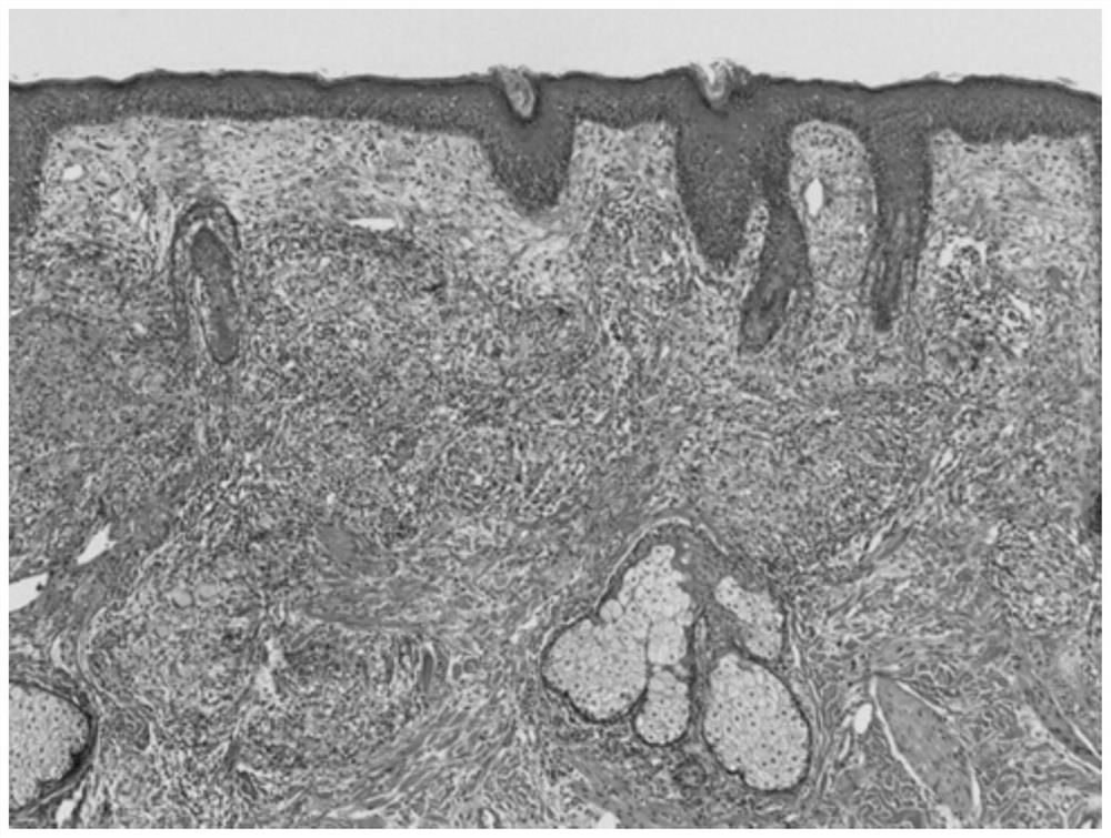 Clinical application of doxycycline hydrochloride dispersible tablets as drug for treating demodicidosis skin lesion