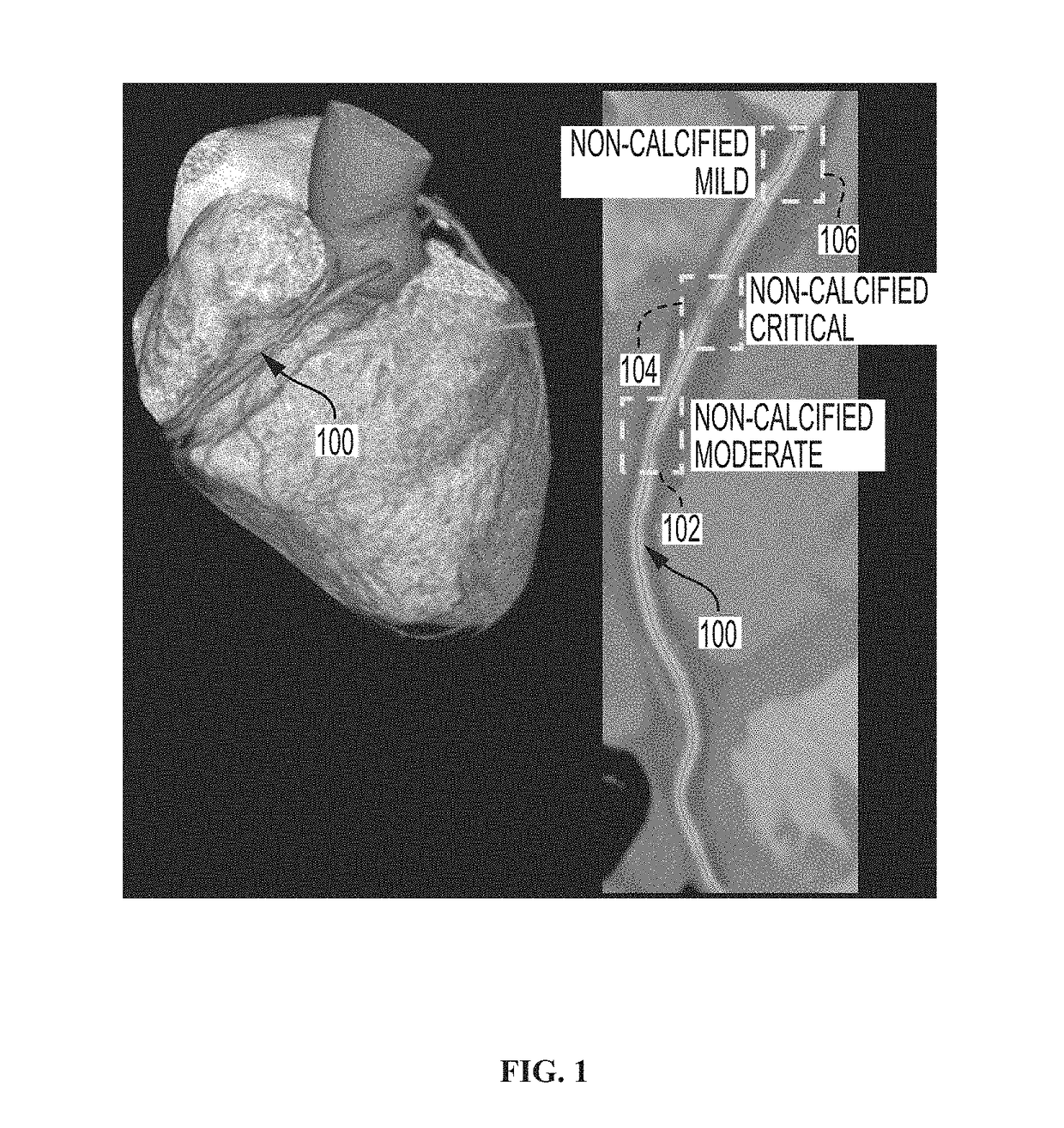 Method and system for vascular disease detection using recurrent neural networks