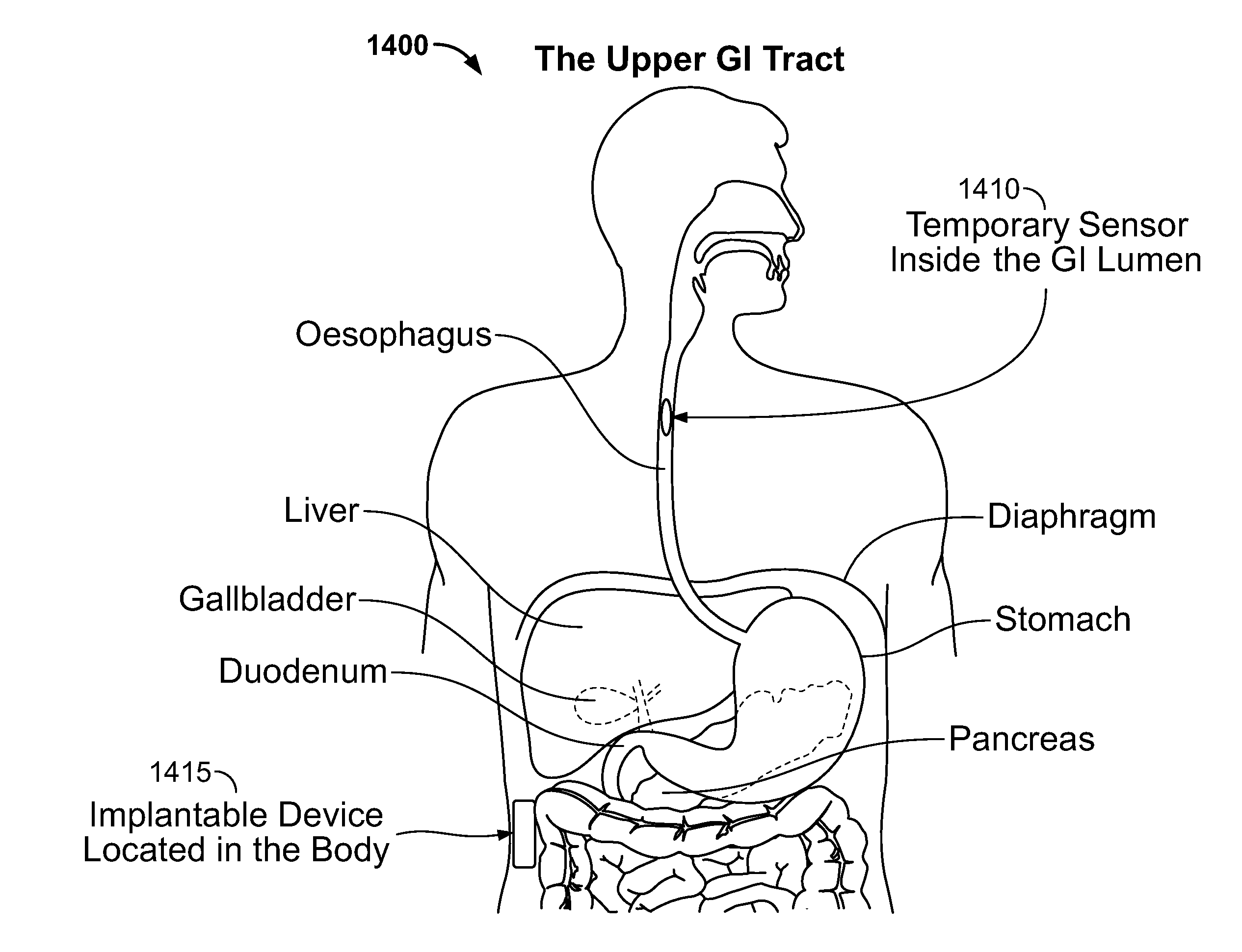 Device and Implantation System for Electrical Stimulation of Biological Systems