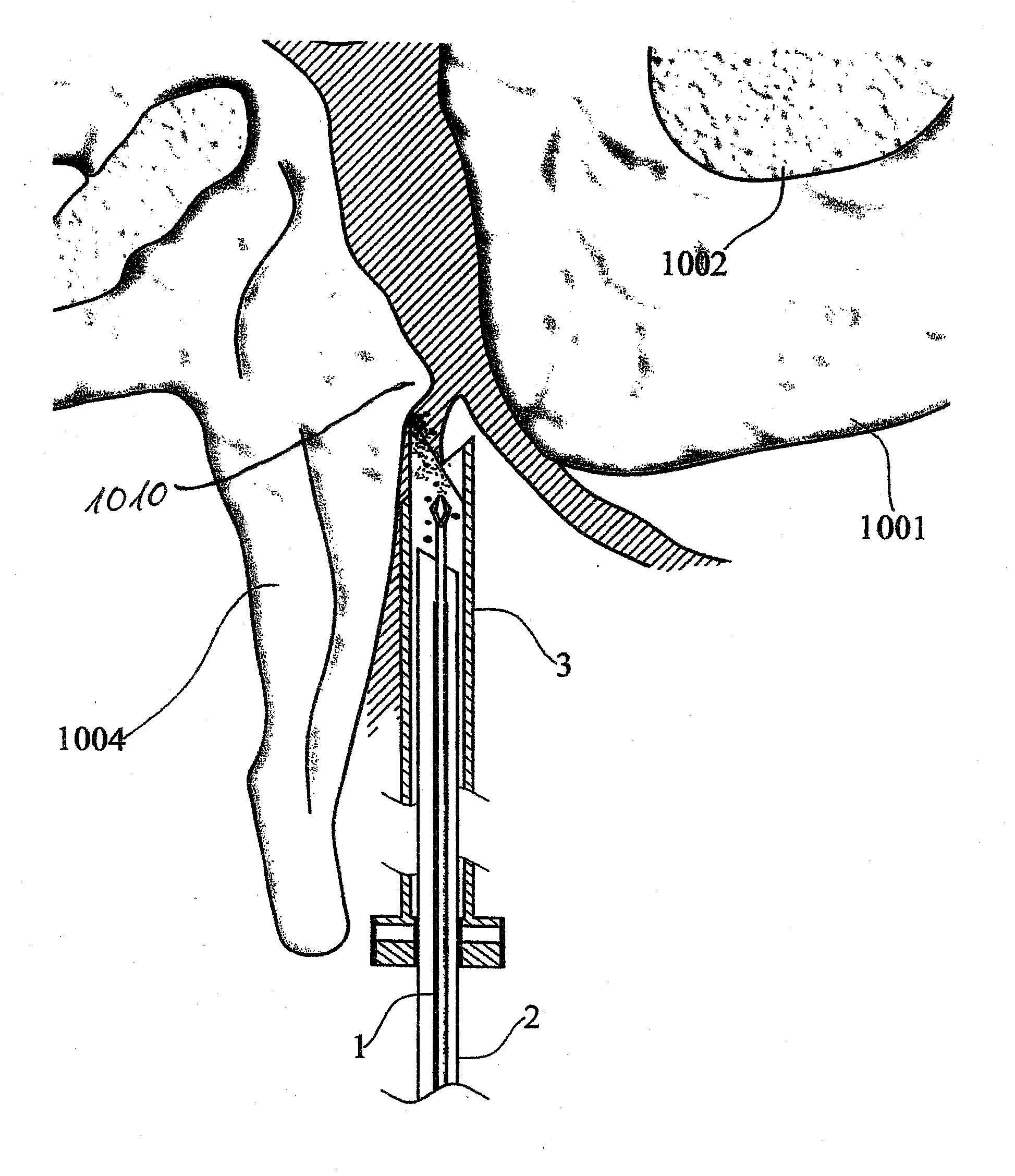 Device and method for minimally invasive spinal intervention