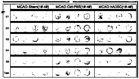 Human-adipose derived adult stem cell-derived neuronal precursor cells and preparation method therefor and application of neuronal precursor cells