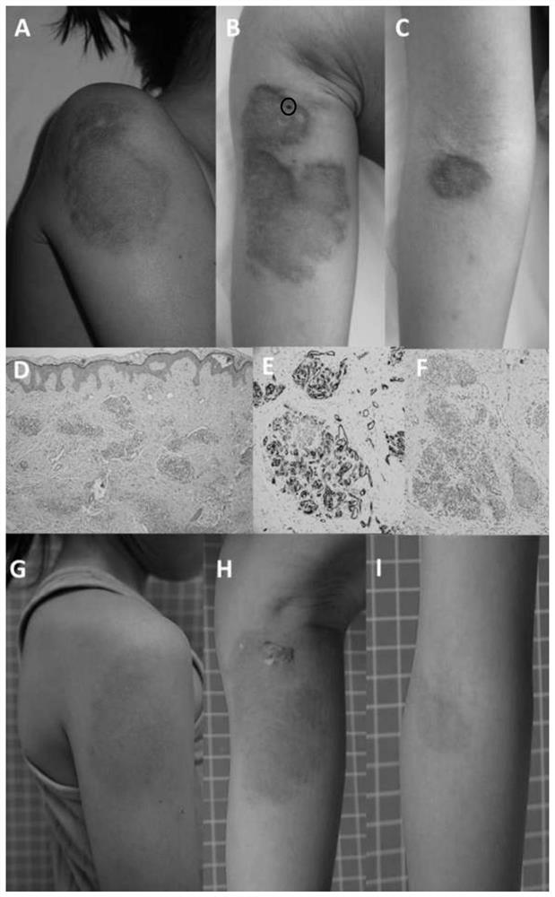 Application of timolol or salts thereof to preparation of medicine for preventing and/or treating plexiform angioma