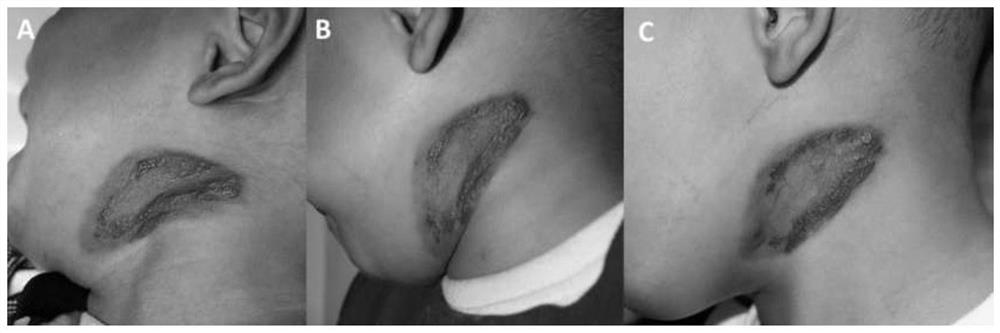 Application of timolol or salts thereof to preparation of medicine for preventing and/or treating plexiform angioma