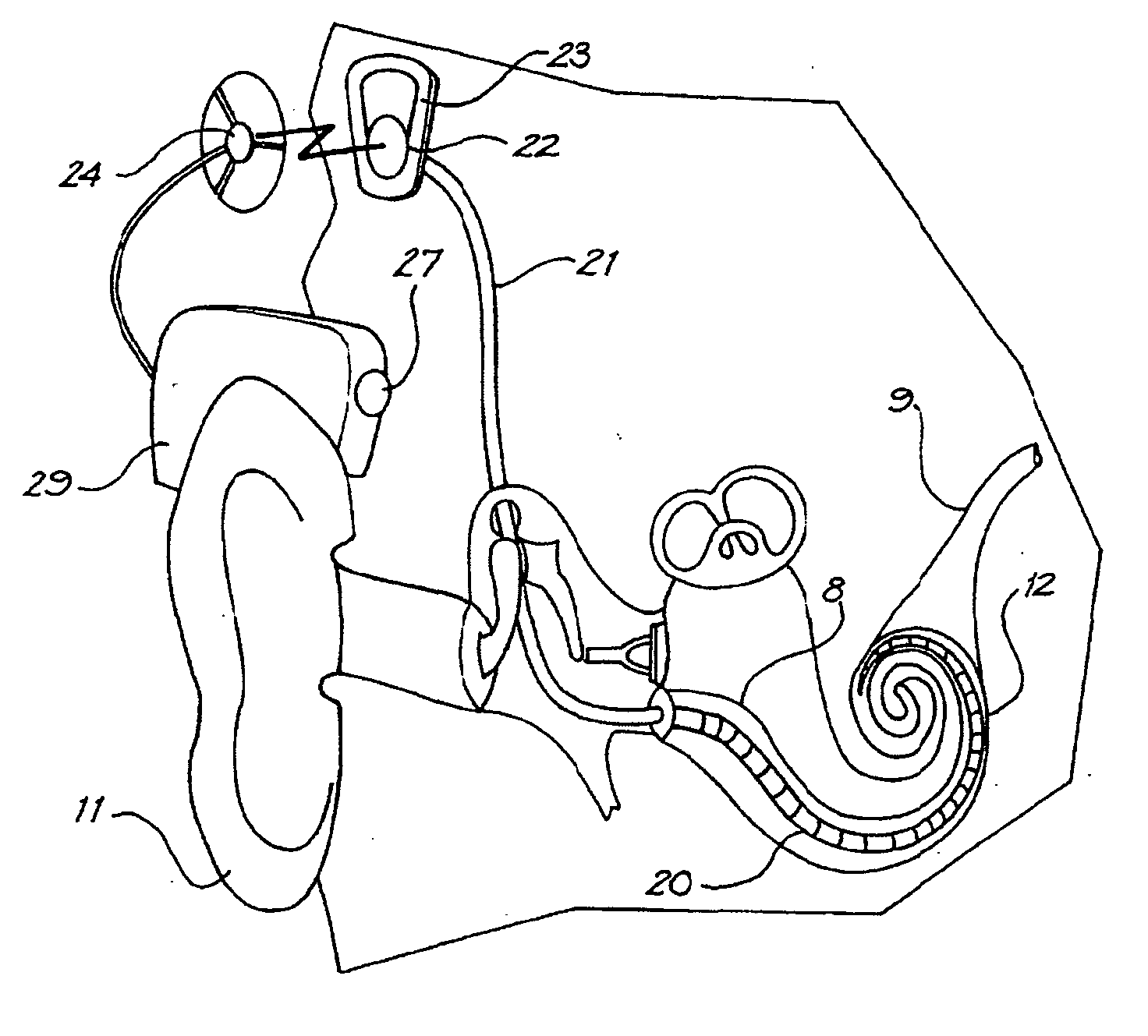 Cochlear implant electrode array