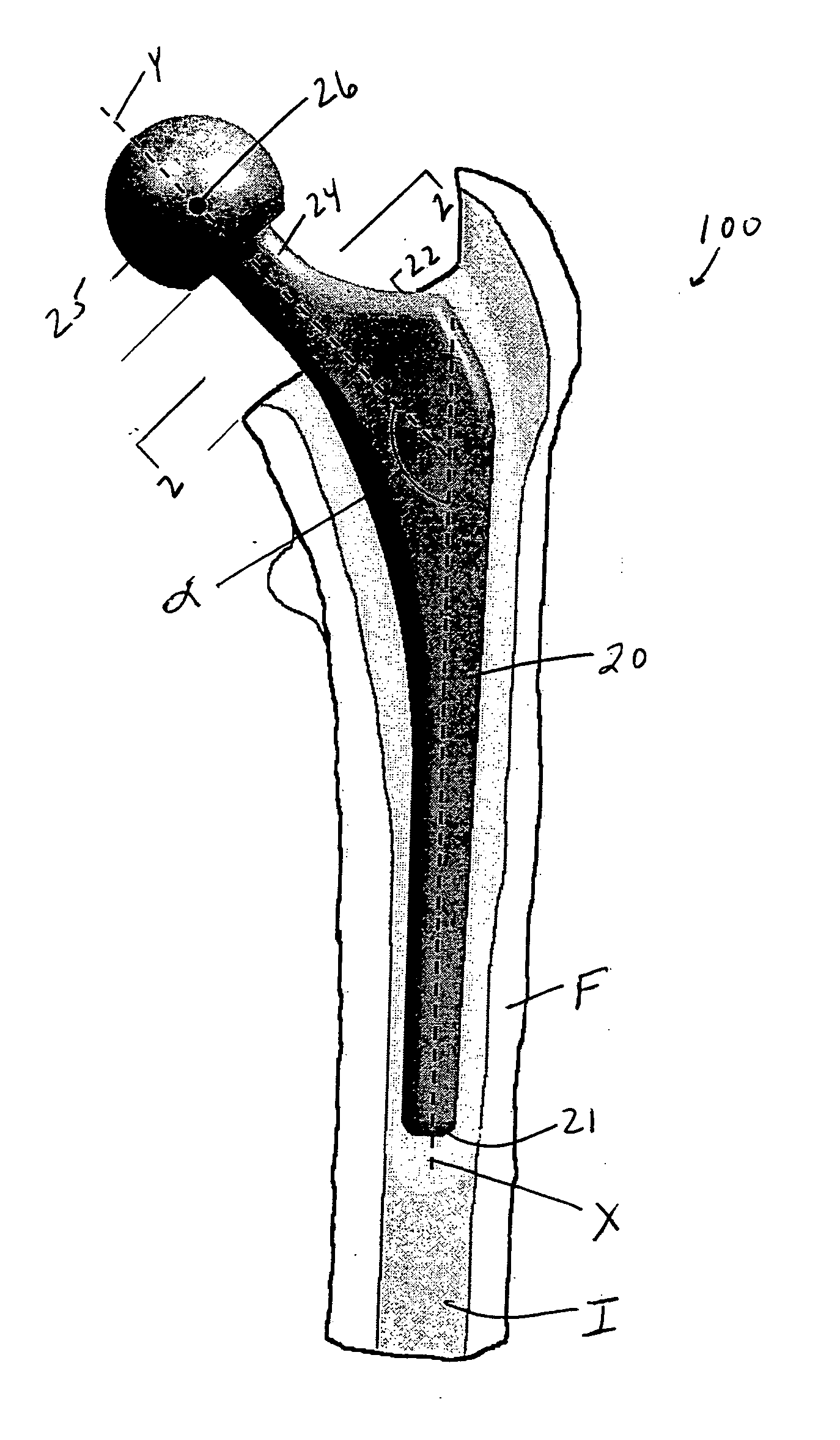 Femoral implant for hip arthroplasty