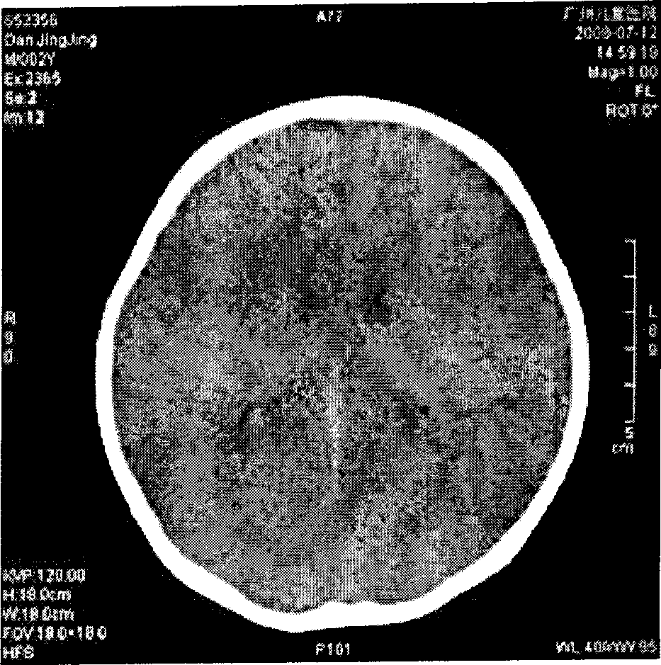 Analysis method for infant brain medical computer scanning images and realization system