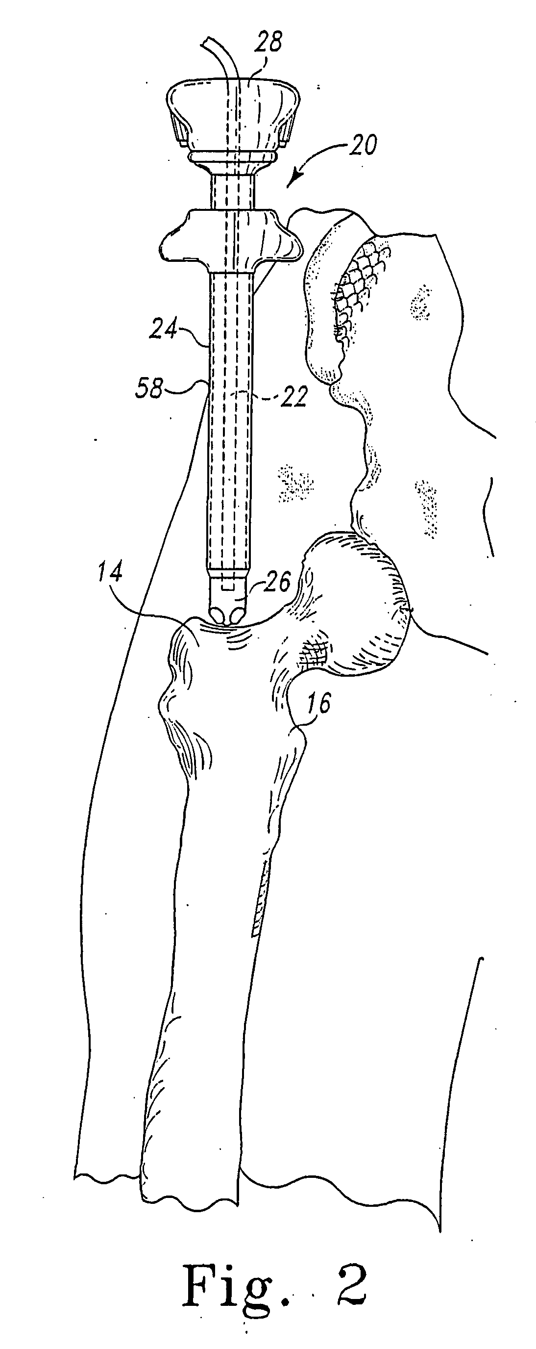 Minimally invasive orthopaedic apparatus and methods