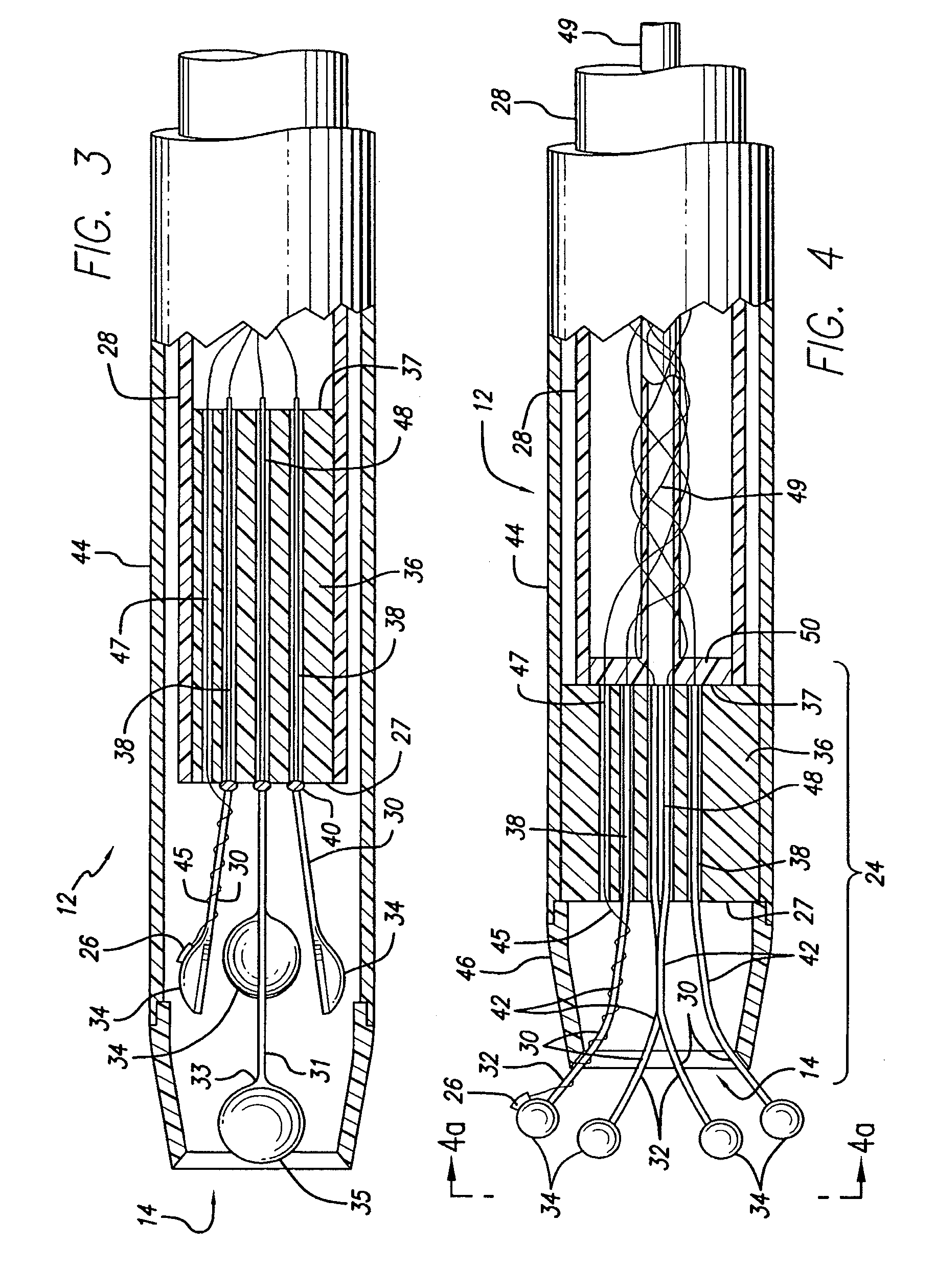 Expandable catheter having two sets of electrodes