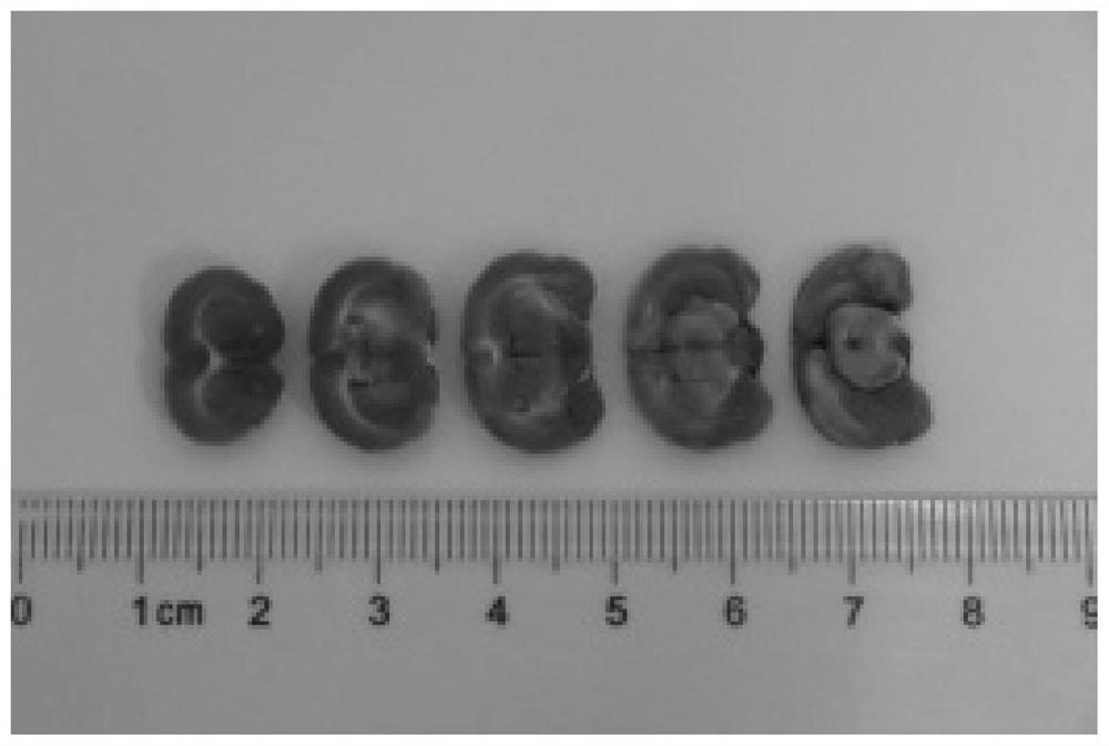 Application of polymerized hemoglobin in preparation of medicine for treating cerebral arterial thrombosis