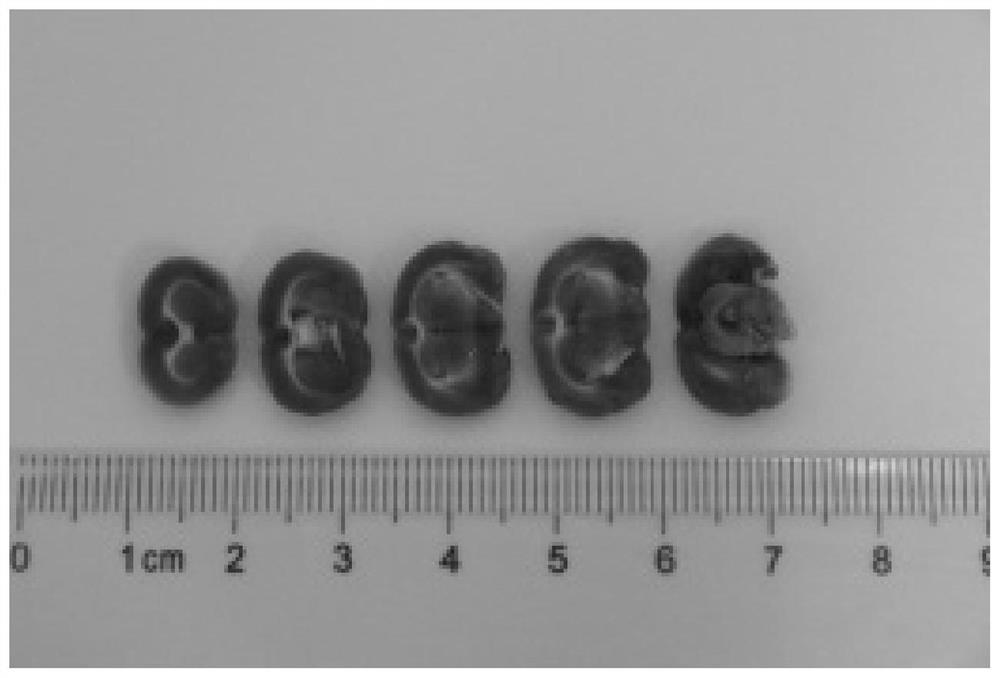 Application of polymerized hemoglobin in preparation of medicine for treating cerebral arterial thrombosis