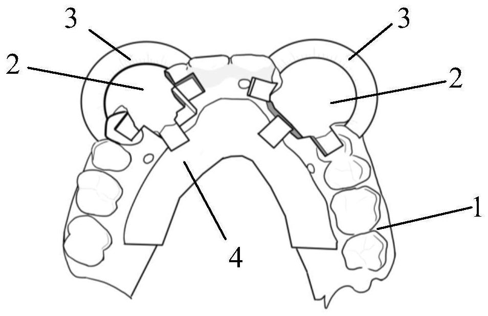 Digital all-in-one guide plate for odontoless jaw implantation and manufacturing method thereof