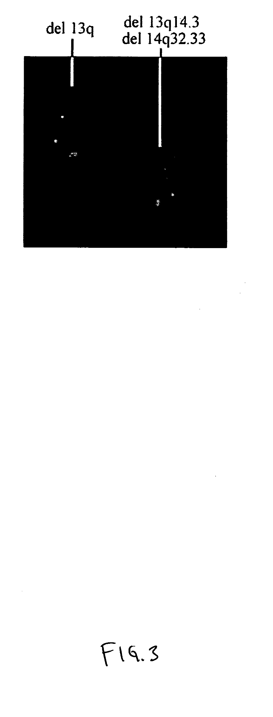 Compositions and methods for diagnosing and treating chronic lymphocytic leukemia