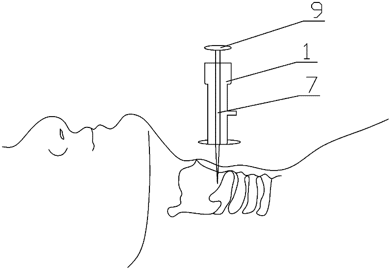 T-shaped air-vent trocar for thyrocricocentesis