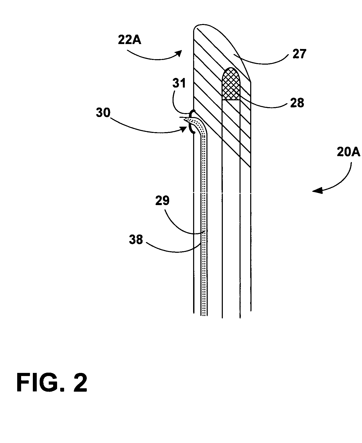 Techniques for transperineal delivery of a denervating agent to the prostate gland