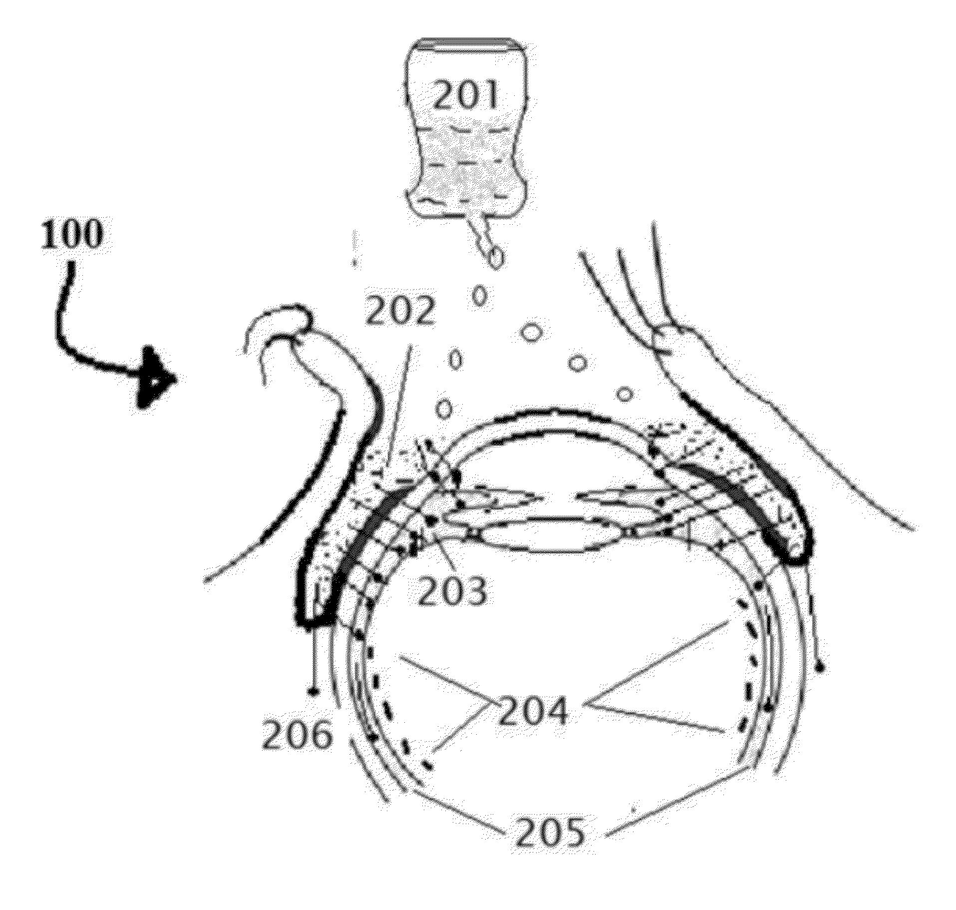 Retinitis pigmentosa treatment