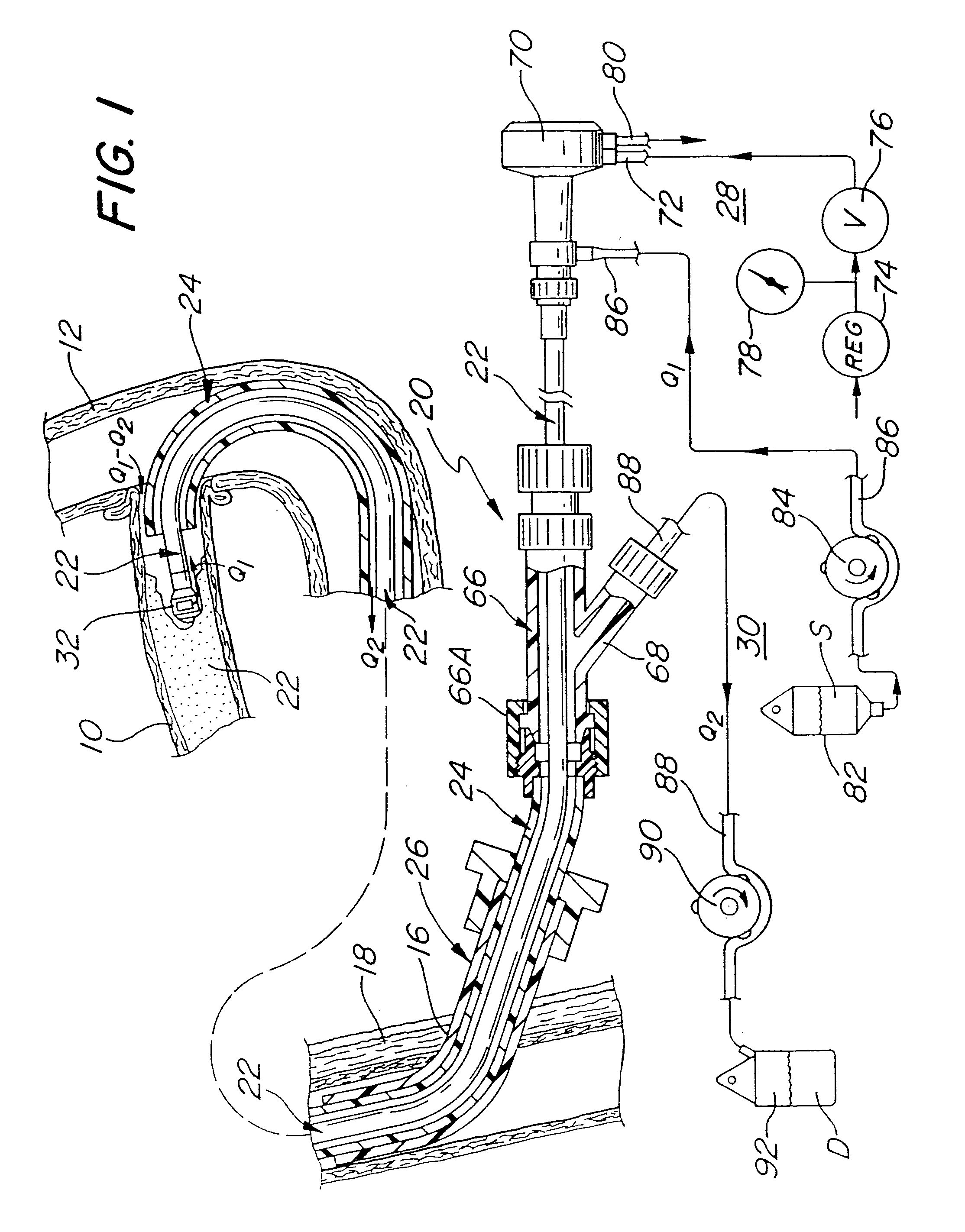 System and method of use for agent delivery and revascularizing of grafts and vessels