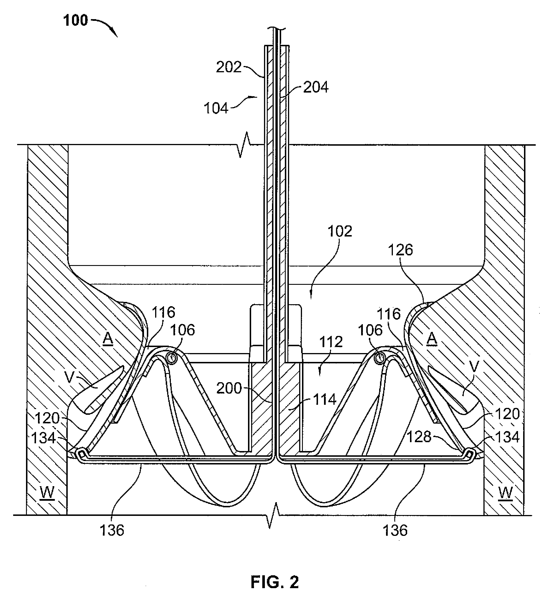 Mitral Valve System