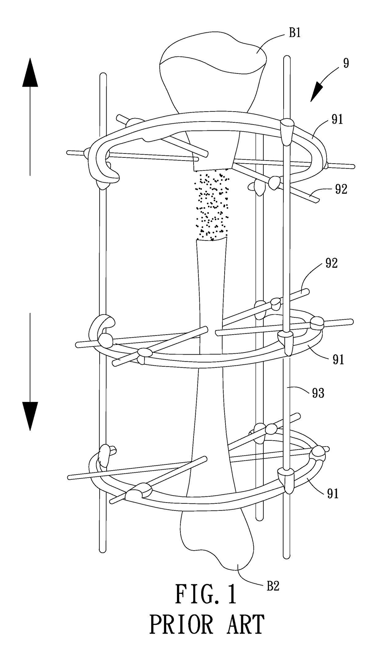 Adjustable external fixator