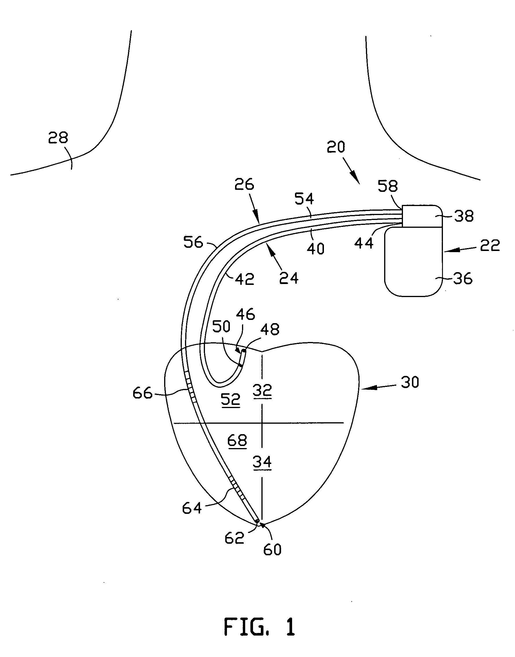 Apparatus and method for treating ventricular tachyarrhythmias