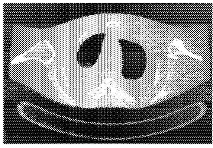 Iterative reconstruction for x-ray computed tomography using prior-image induced nonlocal regularization