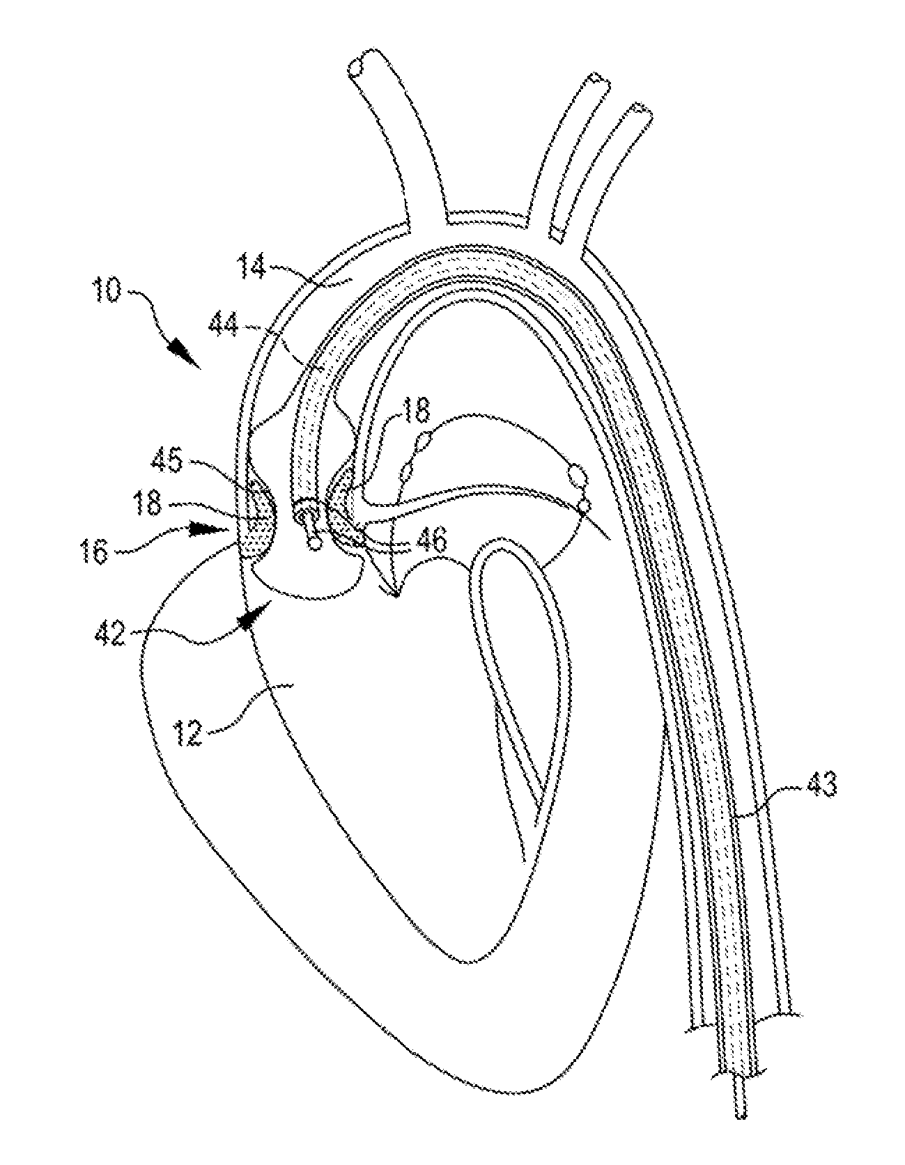 Shockwave valvuloplasty catheter system