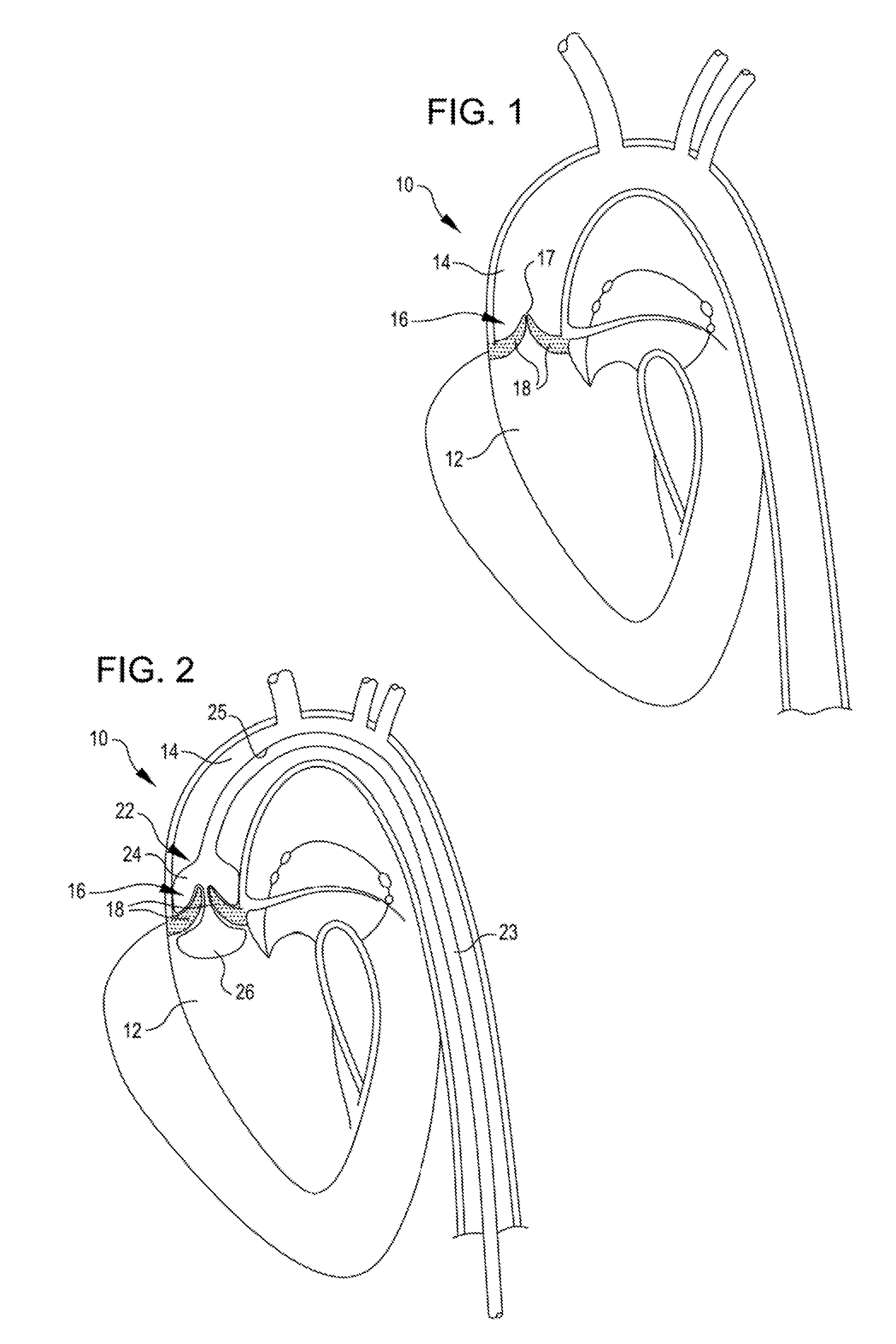 Shockwave valvuloplasty catheter system