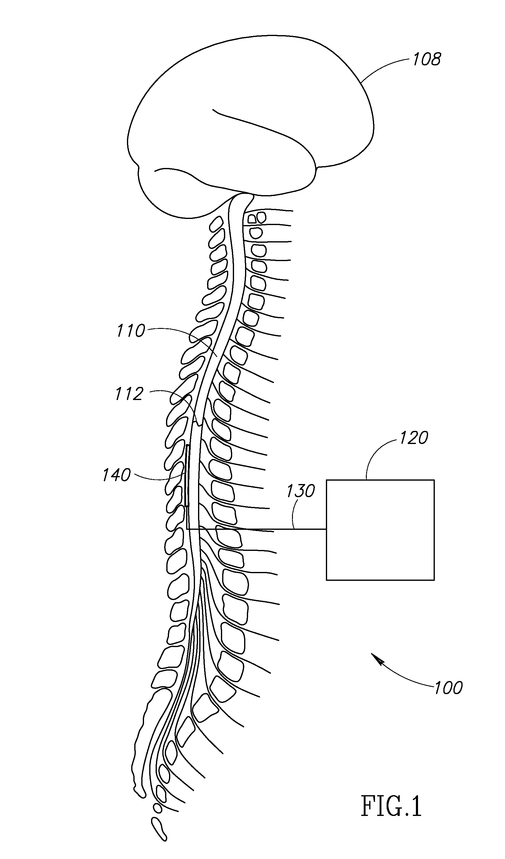 Neurostimulator