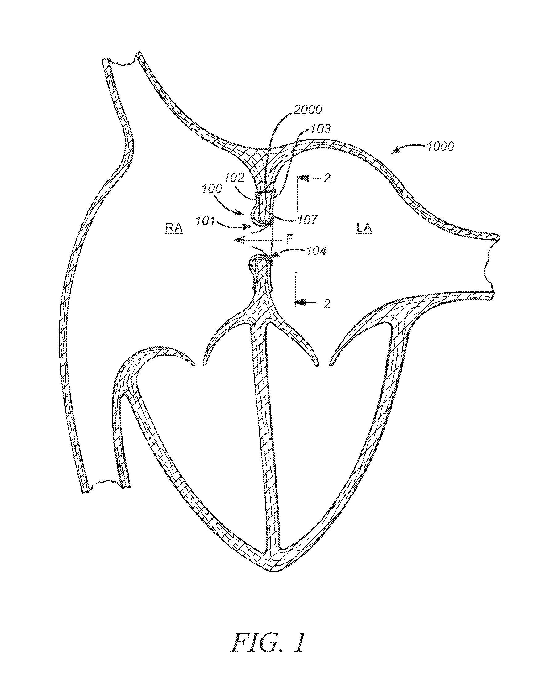 Control devices for deploying a prosthesis