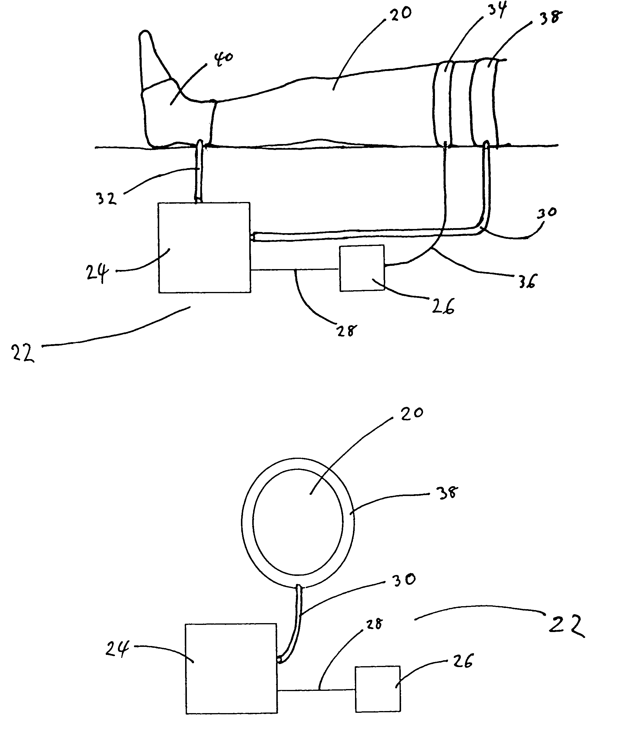 Thrombus prevention apparatus and methods