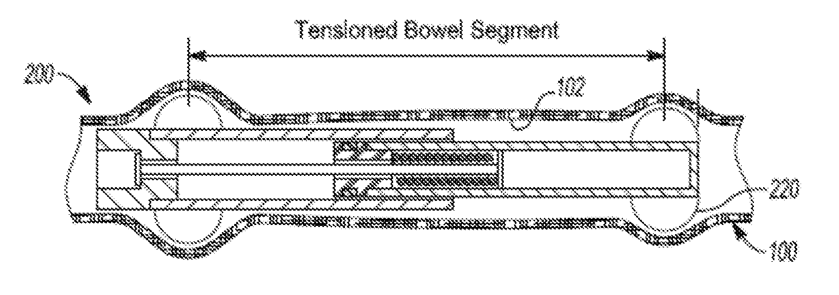 Atraumatic Tip Geometry For Indwelling Devices