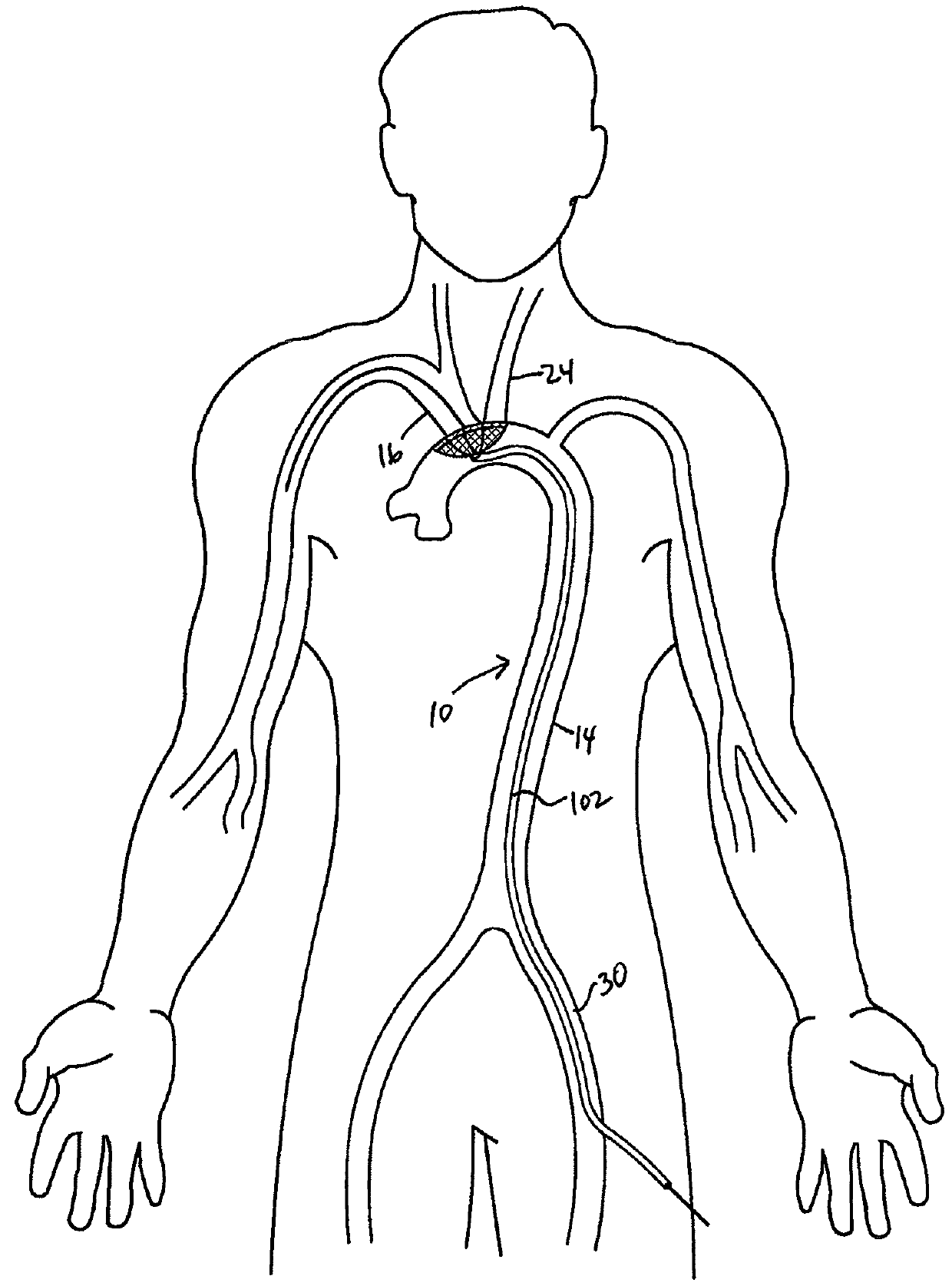 Embolic deflection device