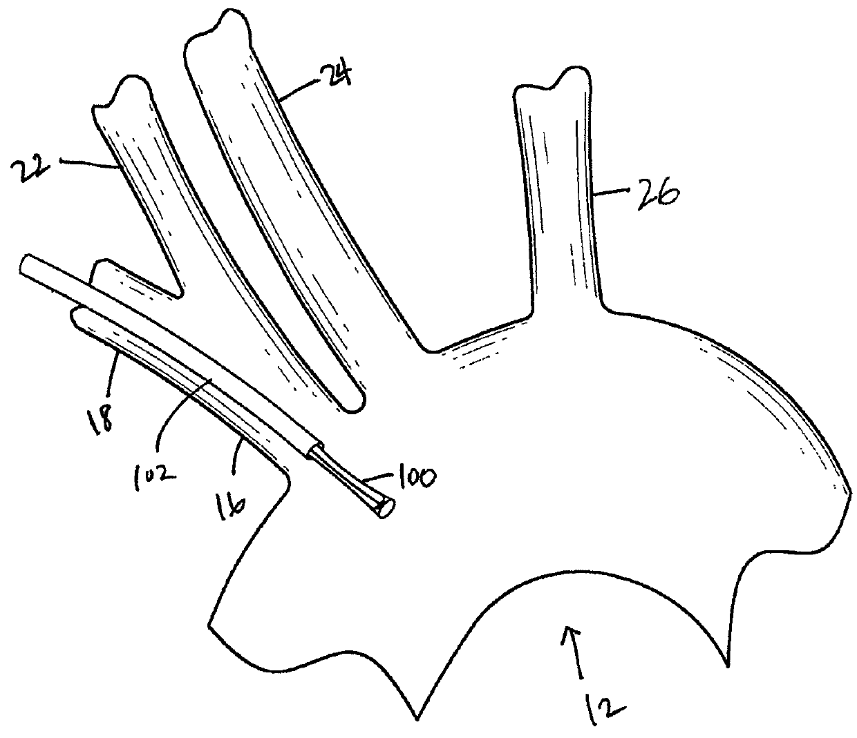 Embolic deflection device