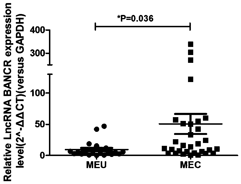 Endometriosis canceration related ovarian cancer diagnostic or prognostic marker and application