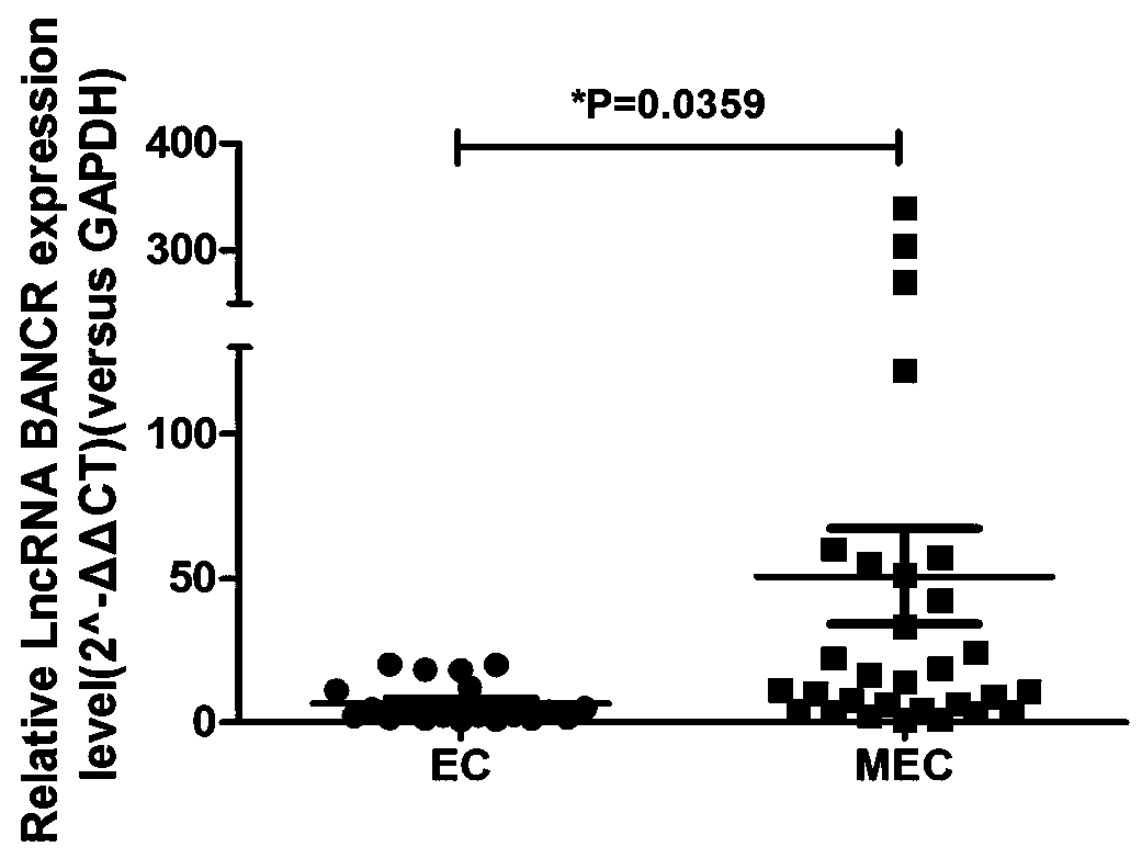 Endometriosis canceration related ovarian cancer diagnostic or prognostic marker and application