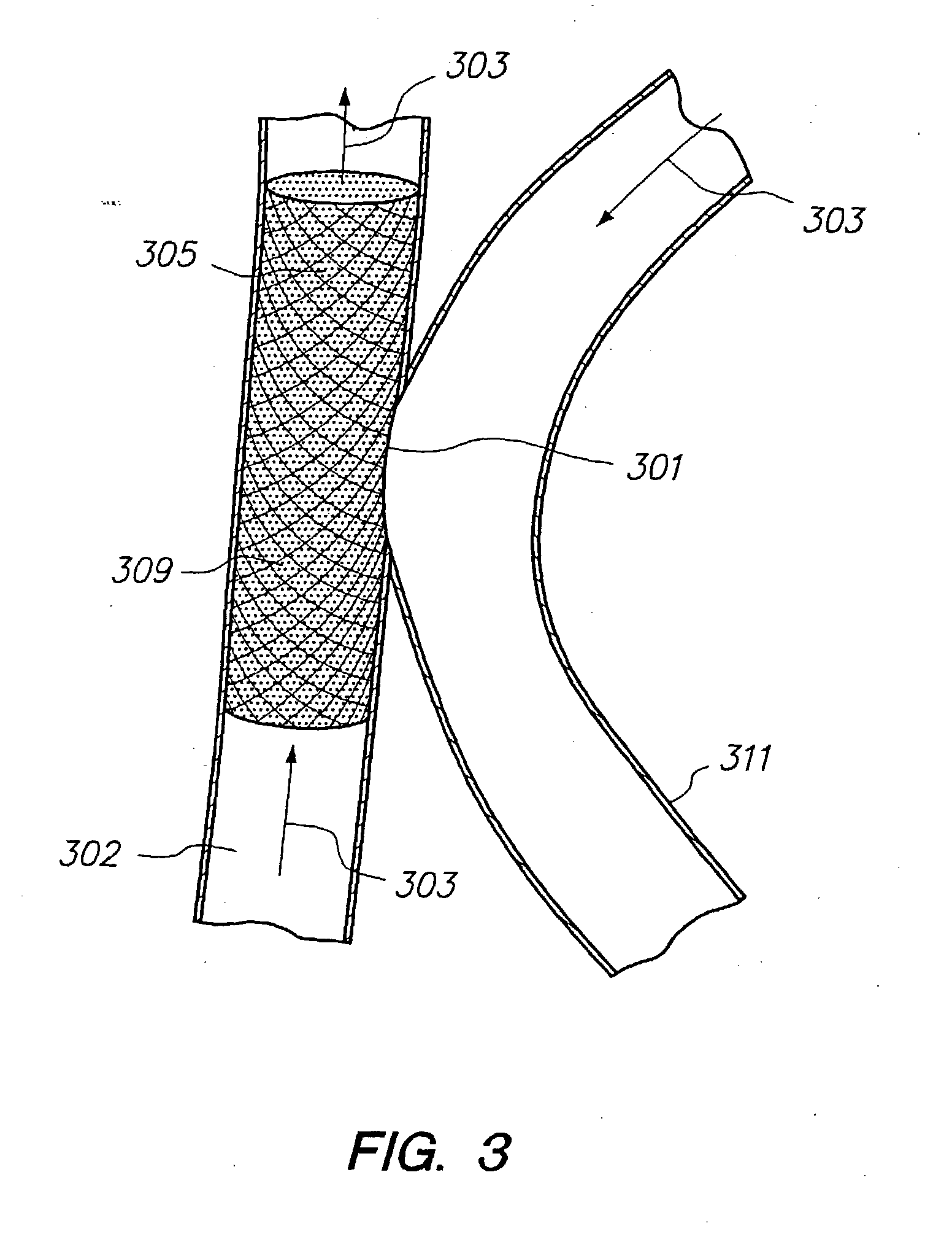 Methods for vascular reconstruction of diseased arteries