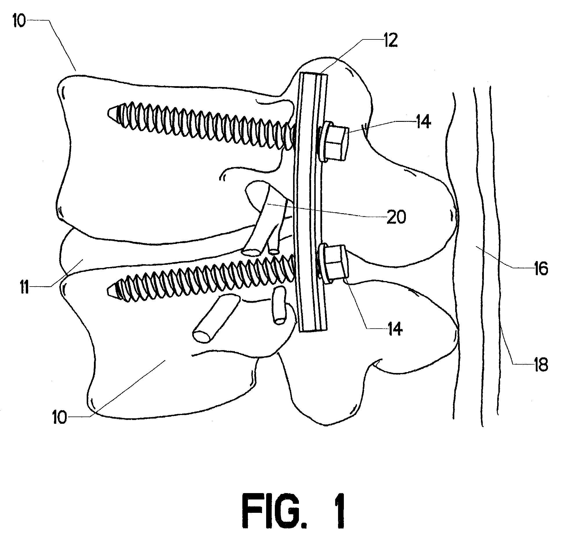 Method for removing orthopaedic hardware