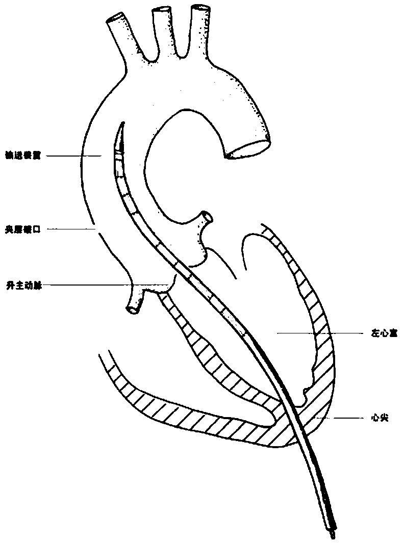 Ascending aorta stent anchored by innominate artery for dissection, and delivery system