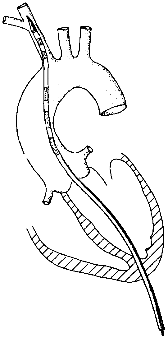 Ascending aorta stent anchored by innominate artery for dissection, and delivery system