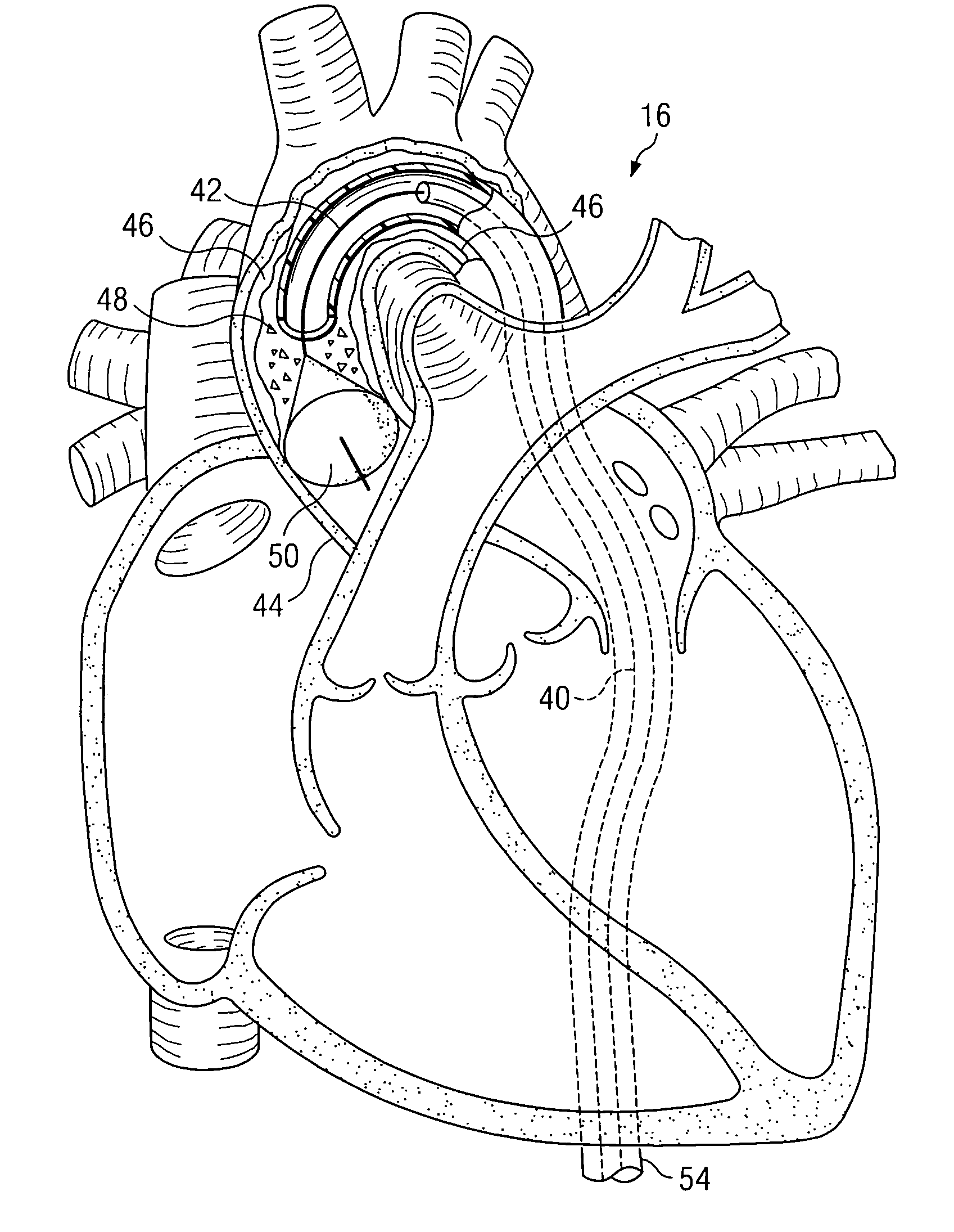 System and method for providing embolic protection