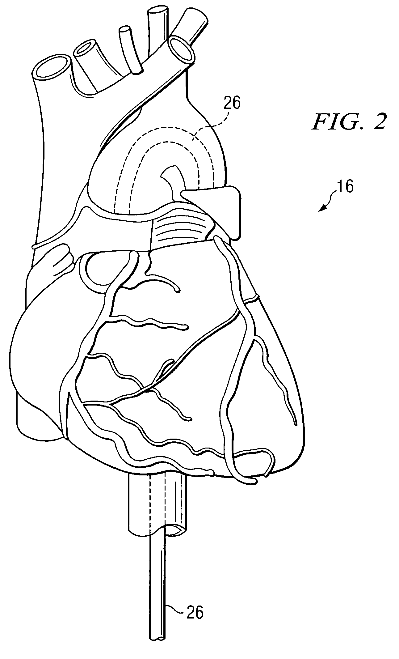 System and method for providing embolic protection