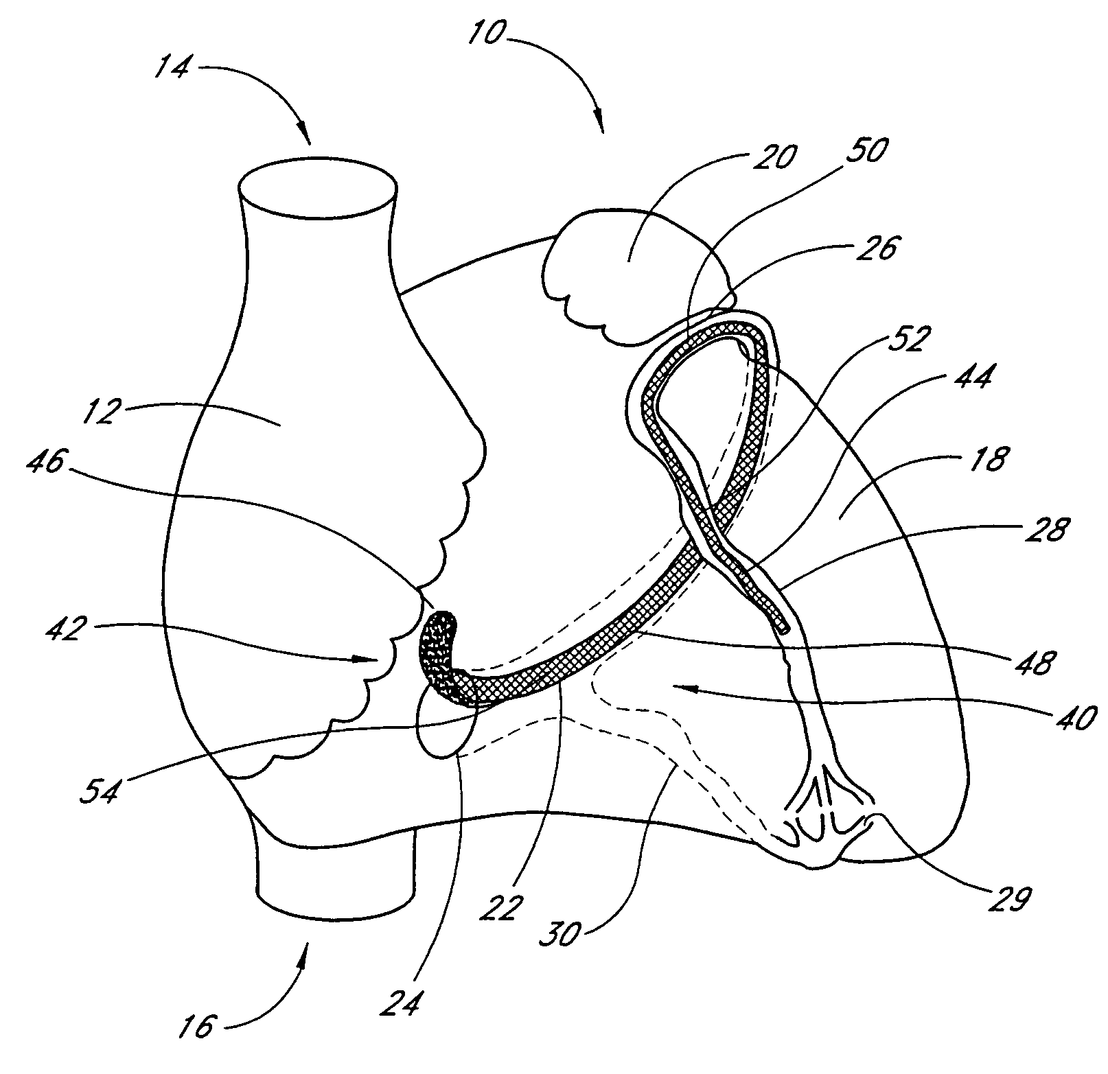 Percutaneous mitral annuloplasty with hemodynamic monitoring